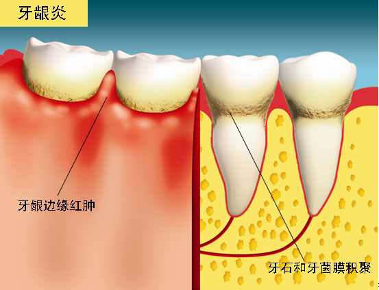 珠海牙科——如何有效預防牙齦炎？