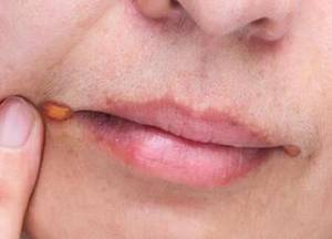 珠海牙科—兒童口角炎是什麼？