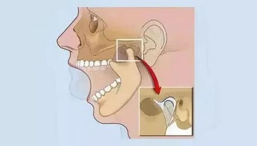 珠海牙科—什麼是顳下頜關節紊亂病？