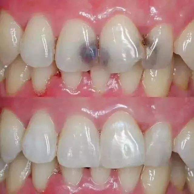 哪些原因會讓你牙齒缺損？