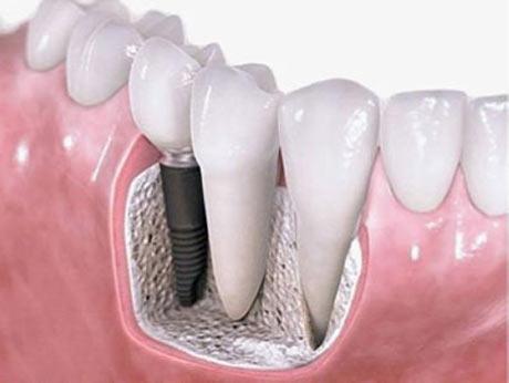 珠海種植牙—種植牙的適應症和禁忌症有什麼？