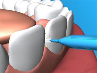珠海牙科-牙齦自發性出血、疼痛、口臭是怎麼回事？什麼是牙周袋？