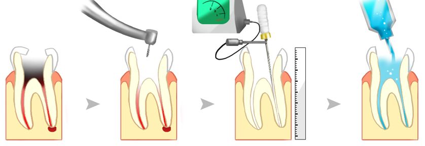 根管治疗1