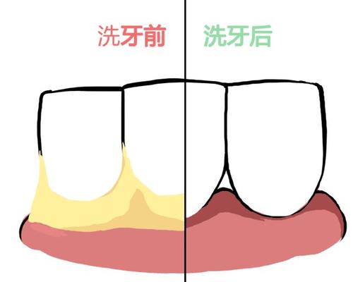 珠海牙科-青春期齦炎是怎麼回事？