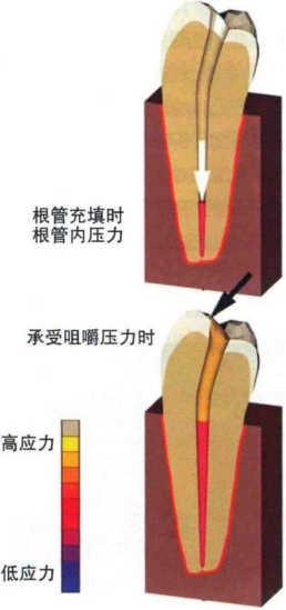 不同的根管錐度對根管壁壓力分佈的影響