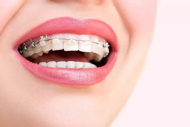珠海牙科-乳牙期如何預防錯頜畸形？