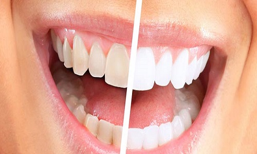 珠海牙齒美白—牙齒漂白的常見問題都在這裡！