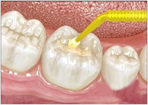 珠海牙科-牙齦腫脹時單純吃消炎藥管用嗎？