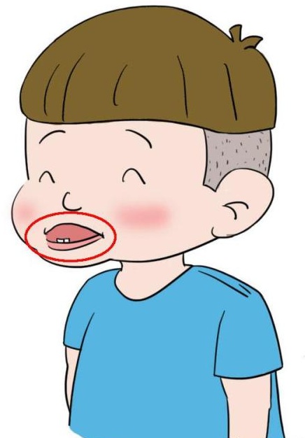 珠海箍牙-孩子“地包天”換牙前需要治療嗎？
