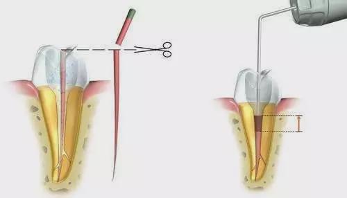 珠海牙科—根管後打樁有什麼作用？