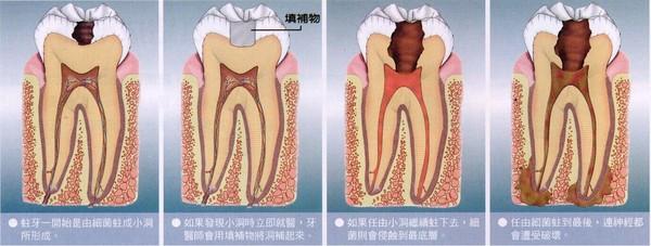 珠海根管治療科普-牙髓病有哪些治療方法？