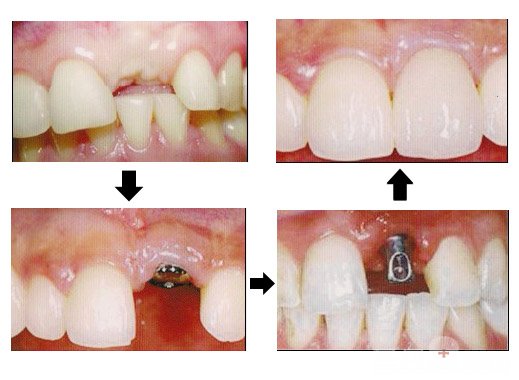 珠海種牙—七步瞭解種植牙全過程