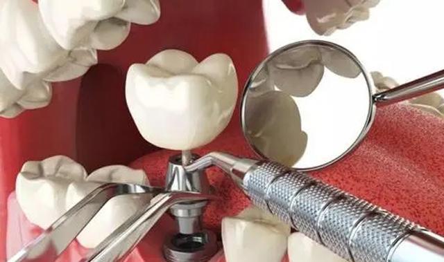 珠海種牙—種植牙能用電動牙刷嗎？