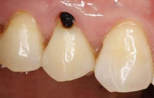 珠海牙科—牙根黑了怎麼辦？