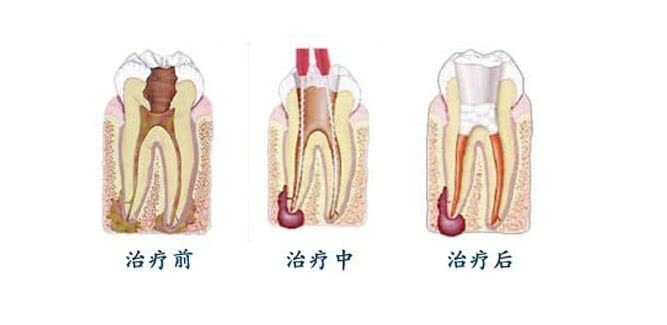 在珠海患了牙髓炎要怎麼治療？