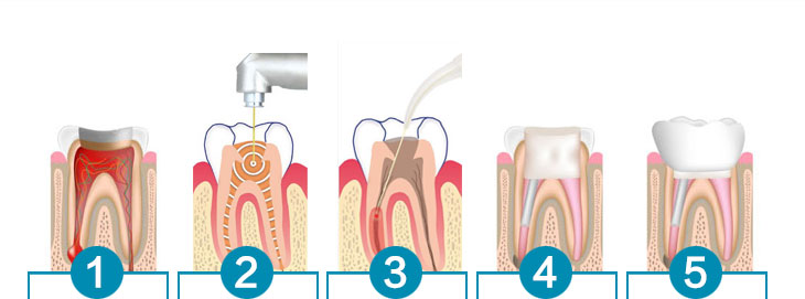珠海牙科—哪些情況需要做根管治療？根管治療安全嗎？