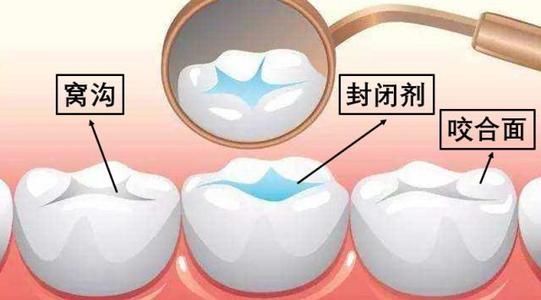 珠海牙科—窩溝封閉對小孩牙齒有害嗎？