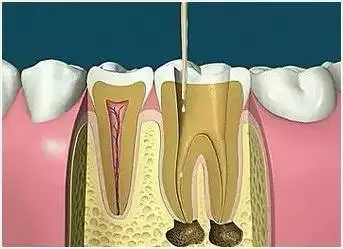 珠海杜牙根過程會比牙髓炎牙痛嘅感覺更痛嗎？