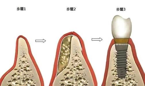 種植牙可以用終生嗎？珠海種植牙推介