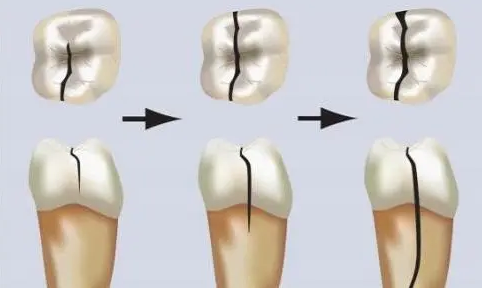 牙齒好敏感，牙醫話有裂紋點算？珠海牙科推介