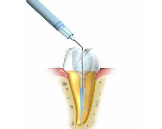 如何判斷牙神經是否壞死？珠海杜牙根推介